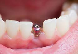 Dental Implants - Statesboro, GA
